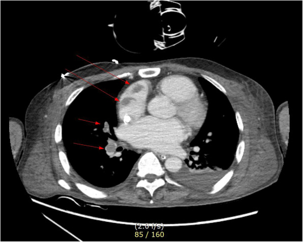Total thyroidectomy performed under general anesthesia with venovenous extracorporeal membrane oxygenation during a thyroid storm: a case report.