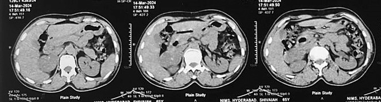 Adrenal Incidentaloma Masquerading as Malignancy: A Rare Case of Ganglioneuroma with Nodal Metastasis.