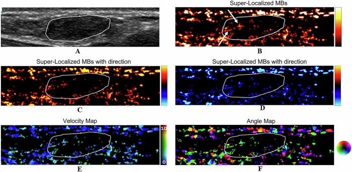 Differentiation of benign and malignant breast lesions by ultrasound localization microscopy.