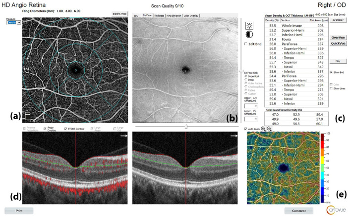 Evaluating the impact of anti-CGRP monoclonal antibodies on retinal features in migraine patients: a retrospective optical coherence tomography study.