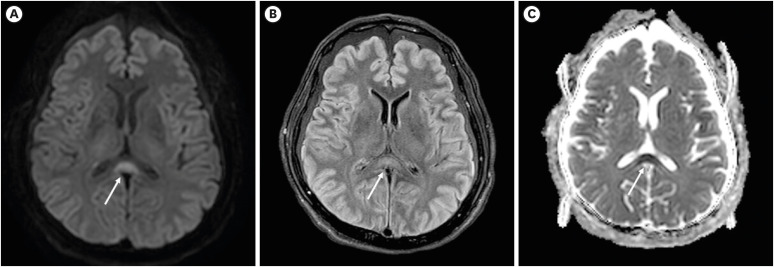 Cytotoxic Lesions of the Corpus Callosum Preceding Osmotic Demyelination Syndrome in Hypernatremia and Hyperosmolar Hyperglycemic State: A Case Report.
