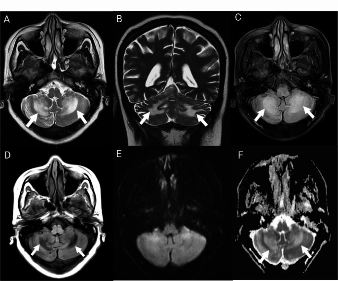 Isolated Bilateral Cerebellar Dysfunction as the Initial Manifestation of HIV Infection: A Diagnostic Challenge, Case Report, and Literature Review.