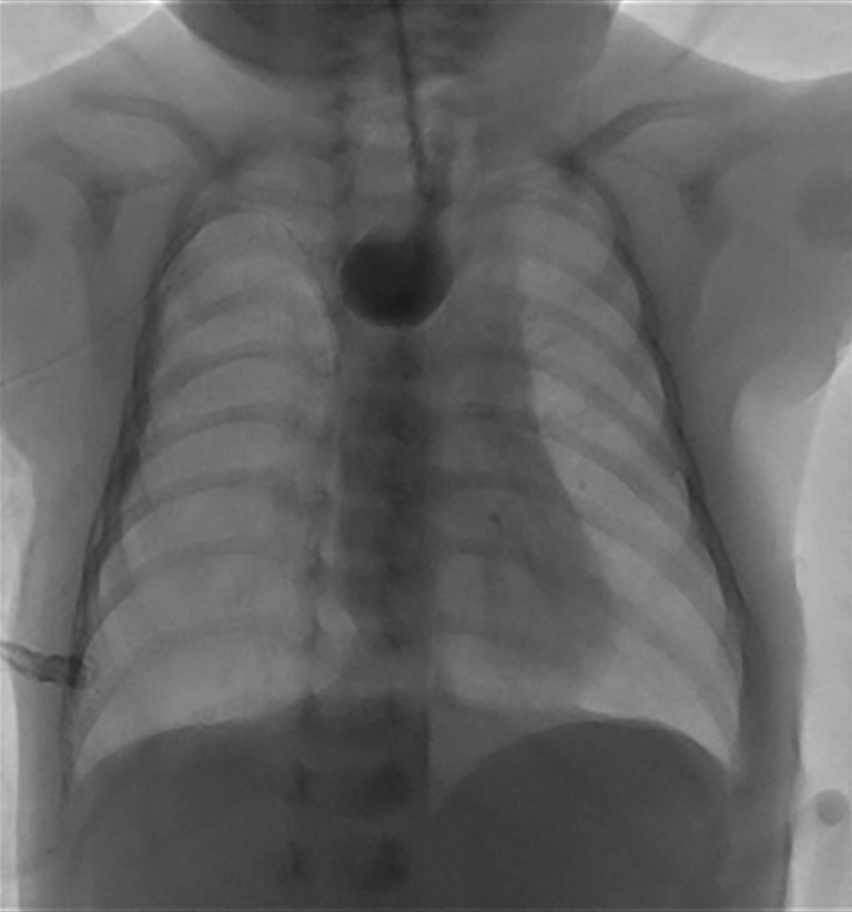 Balloon dilation therapy for managing anastomotic strictures subsequent to surgical correction of esophageal atresia.
