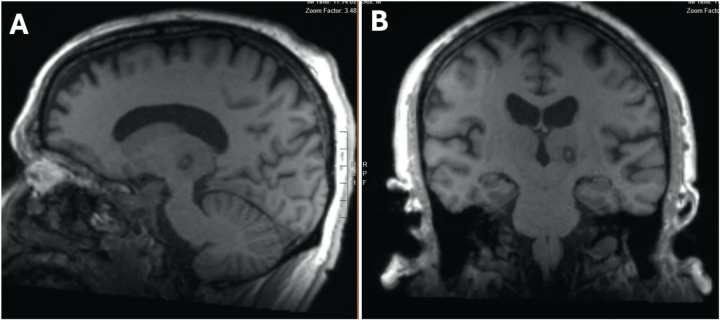 New technique for direct targeting of the ventral intermediate nucleus using magnetic resonance-guided focused ultrasound.