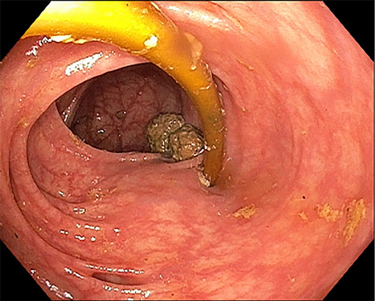 Gastric banding adjustment catheter dislodgement and perforation into the colon: case report.