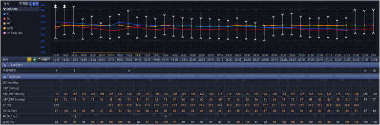 Total thyroidectomy performed under general anesthesia with venovenous extracorporeal membrane oxygenation during a thyroid storm: a case report.