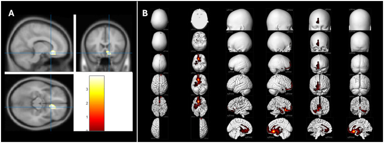 Emotional stress during the COVID-19 lockdown: how negative X/Twitter posts correlated with changes in the brain's fear network.