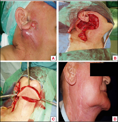 Exploring the use of submental flap for parotid region reconstruction: a multicentric experience.