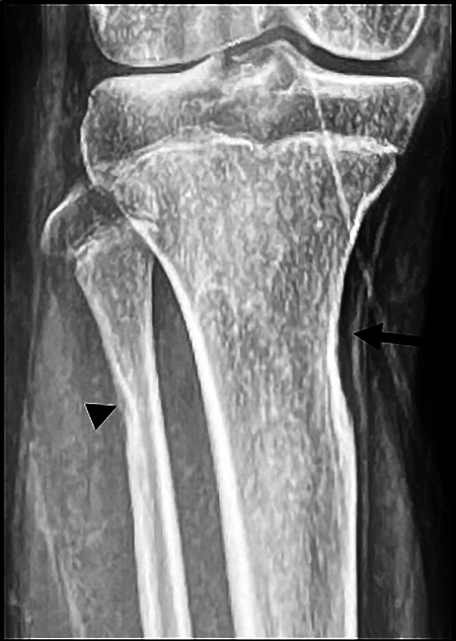 Confounding Association of Lower Limb Hypertrophy With Retarded Long Bone Growth in Mosaic Somatic Neurofibromatosis 1-A Genetic Review and Femoral Lengthening Treatment.
