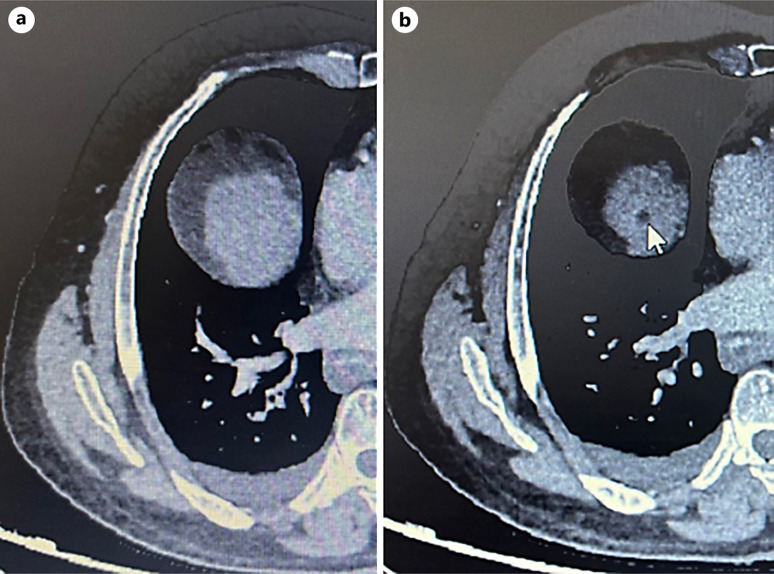 Spontaneous Necrosis of Hepatocellular Carcinoma in Viral B Cirrhosis: A Case Report.