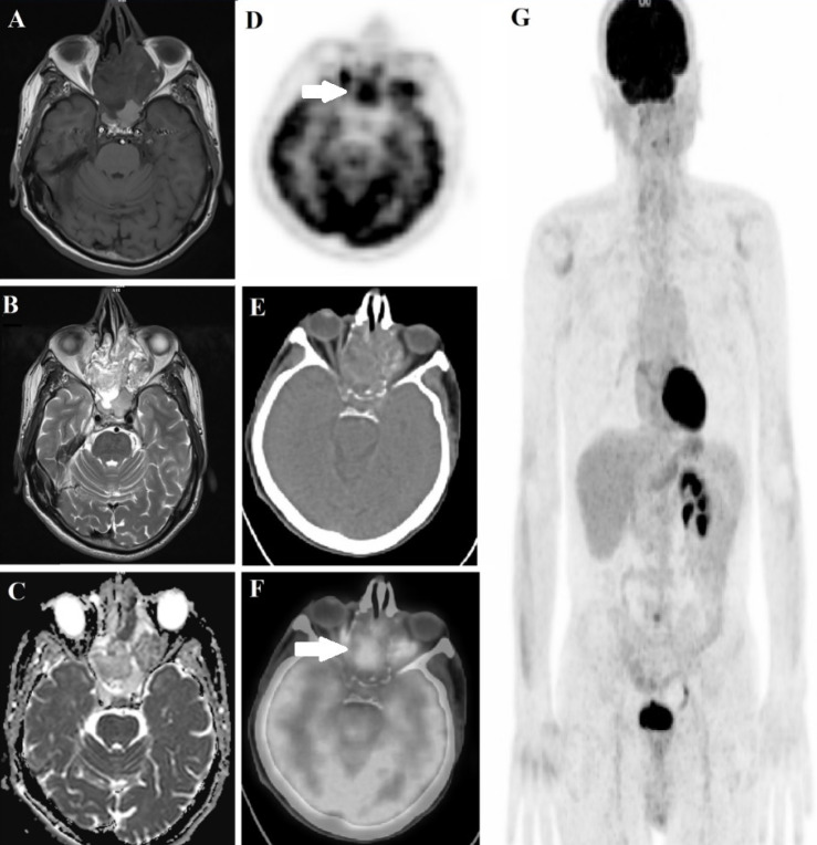 <sup>68</sup>Ga-PSMA-Avid Sinonasal Intestinal-Type Adenocarcinoma.