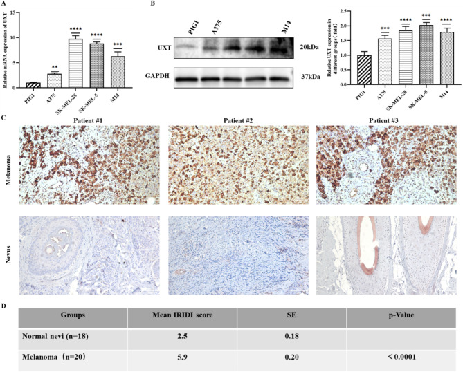 UXT enhances melanoma proliferation, migration, and invasion through modulation of the P53 signaling pathway.