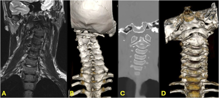 Magnetic Resonance Imaging-Generated Synthetic Computed Tomography in Pediatric Spine Patients.