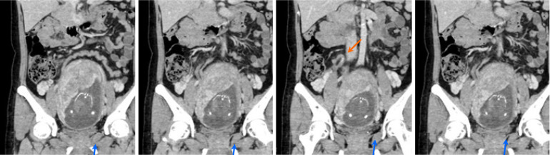 Retrospective analysis of computed tomography examinations in patients with lower abdominal pain: A single-center experience.