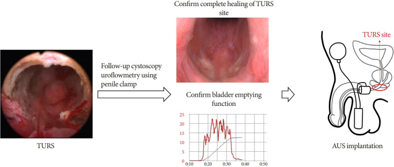 Transurethral Sphincterotomy and an Artificial Urinary Sphincter - A Novel 2-Stage Surgery for Refractory Bladder Emptying Disorders: A Proof-of-Concept Study.