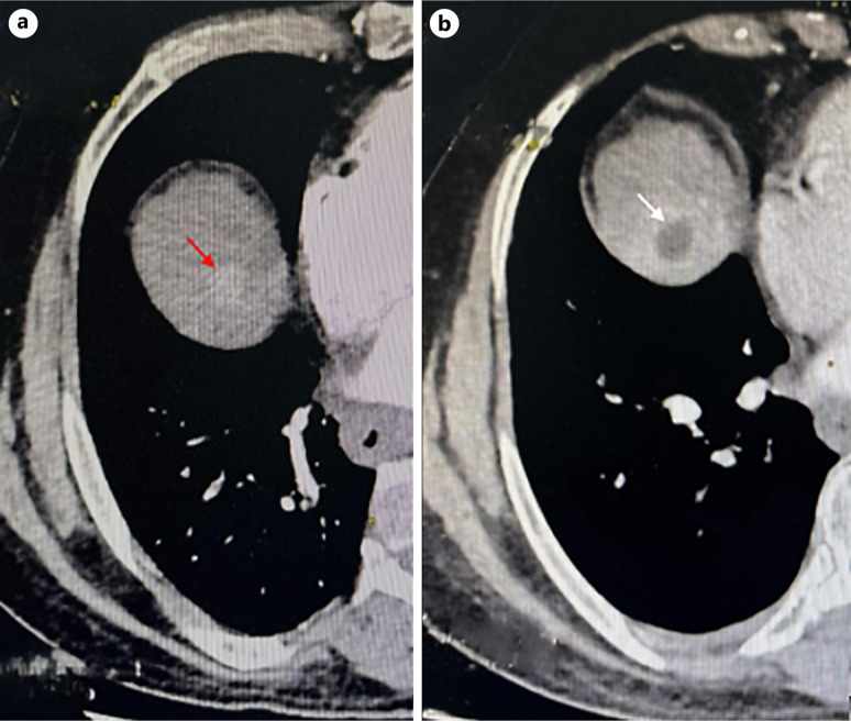 Spontaneous Necrosis of Hepatocellular Carcinoma in Viral B Cirrhosis: A Case Report.