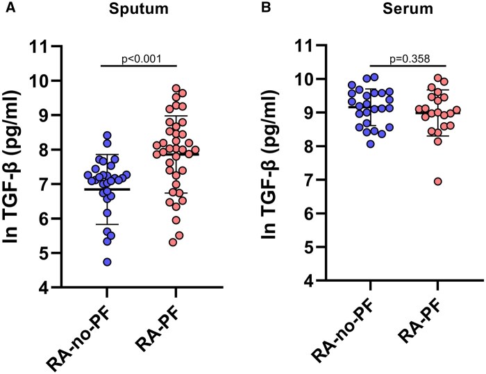 Transforming growth factor-beta is increased in sputum from individuals with rheumatoid arthritis-associated pulmonary fibrosis.