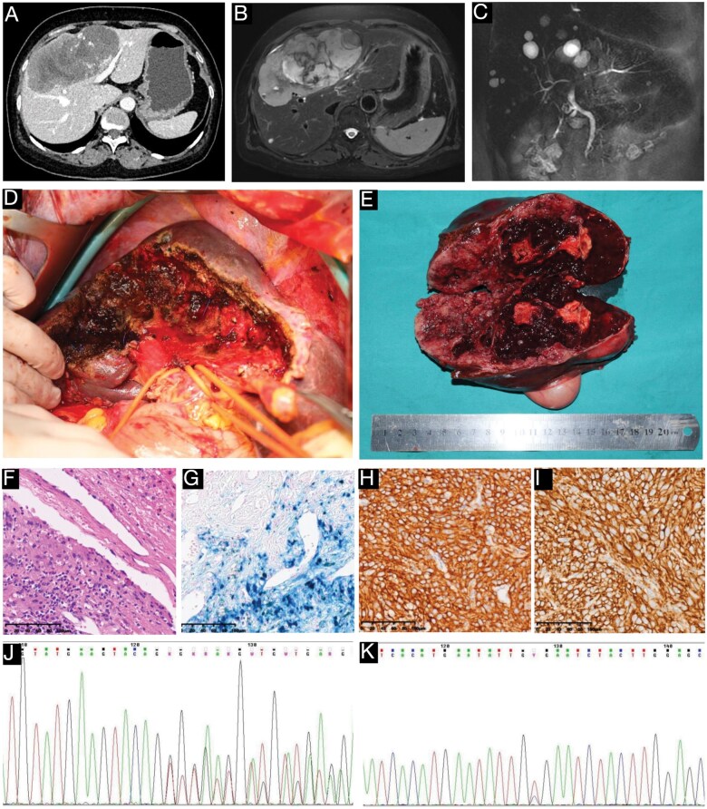 A case of metachronous liver metastasis in small intestinal gastrointestinal stromal tumor: real-world integration of targeted therapy and hepatectomy 14 years after initial resection.