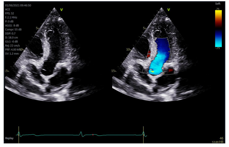 Can automation and artificial intelligence reduce echocardiography scan time and ultrasound system interaction?