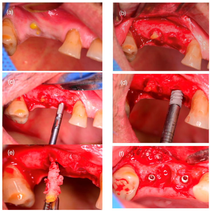 Alveolar Ridge Preservation Using Three-Dimensional Root Replicas of Polycaprolactone: A Radiological and Histological Evaluation of a Case Report.