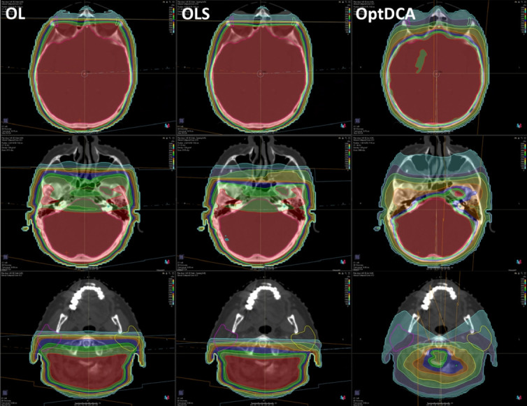 Dosimetric analysis of different whole brain radiotherapy treatment planning methods: three types of 3-dimensional versus hippocampal avoidant.