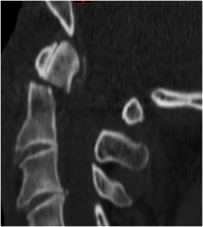 Treatment practices for geriatric type II odontoid fractures - A survey by the European Association of Neurosurgical Societies Spine Section.