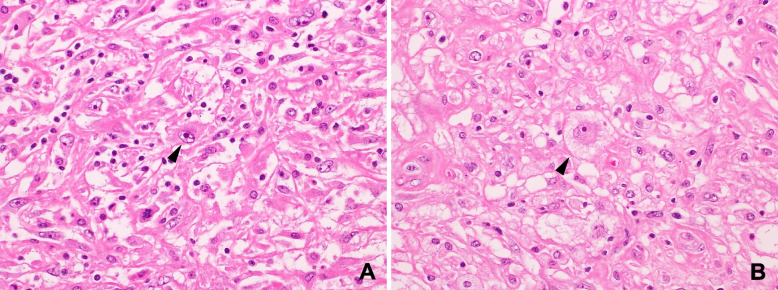 Heterochronic pelvic high-grade myxoinflammatory fibroblastic sarcoma and uterine endometroid carcinoma harboring common gene mutations: a rare case report with genomic analysis.