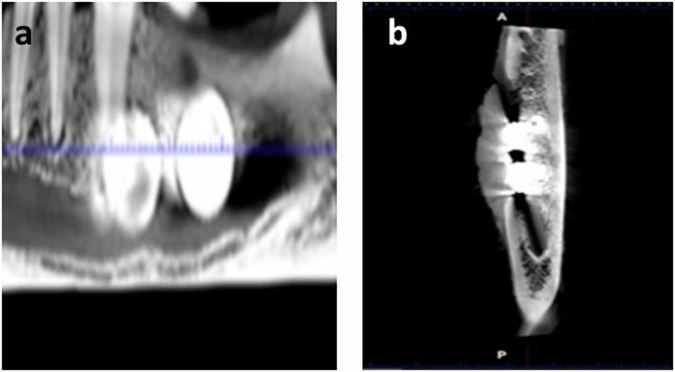 Osteogenic potential of nanostructured Cu/W/Co in Fe-Mn alloys designed for maxillofacial applications: in vivo study in dog model.