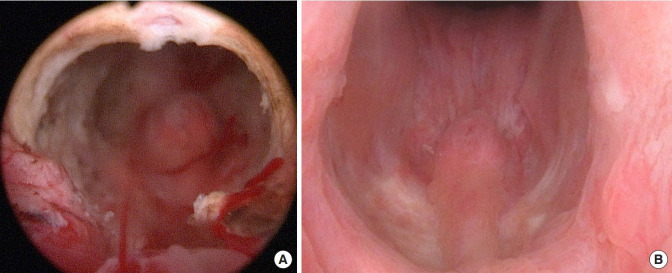 Transurethral Sphincterotomy and an Artificial Urinary Sphincter - A Novel 2-Stage Surgery for Refractory Bladder Emptying Disorders: A Proof-of-Concept Study.