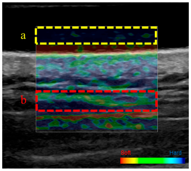 Effects of Trapezius Muscle Self-Stretching on Muscle Stiffness and Choroidal Circulatory Dynamics: An Evaluation Using Ultrasound Strain Elastography and Laser Speckle Flowgraphy.