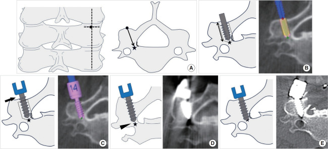 Optimization of Paravertebral Foramen Screw Placement: A Stepwise Approach Considering O-arm Navigation Errors: Technical Note and Case Series.