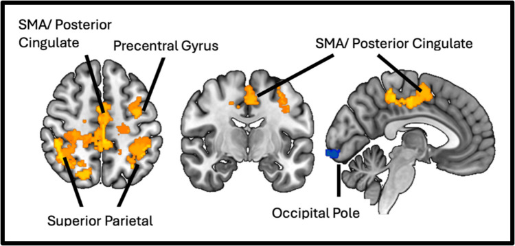 Reduced automaticity in freezing of gait is associated with elevated cortico-cerebellar connectivity.