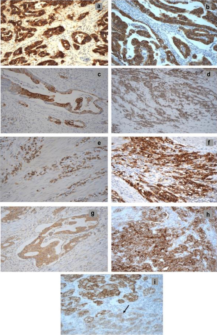 Co-expression of HER2/EGFRvIII/CD44 and Claudin 18.2/CD109 as Novel Prognostic Indicators in Stomach Adenocarcinoma.