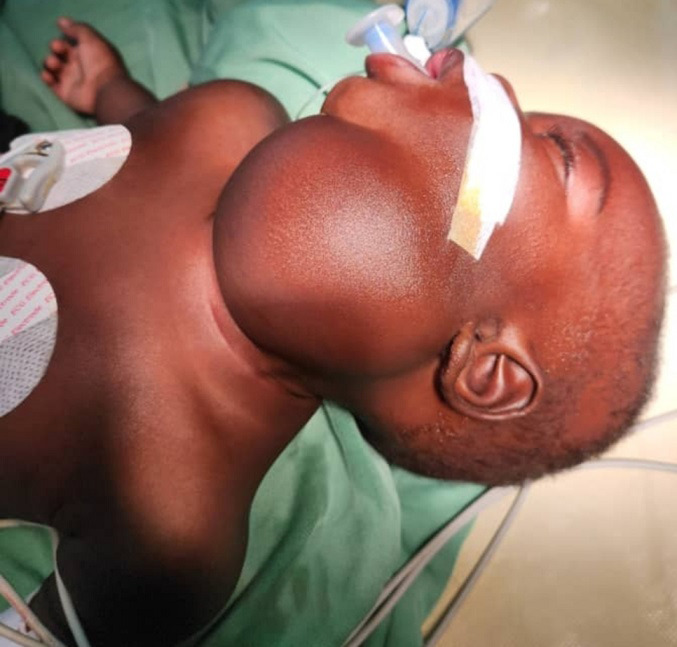 [Giant laterocervical lipoma in a 6-month-old infant: a case report].