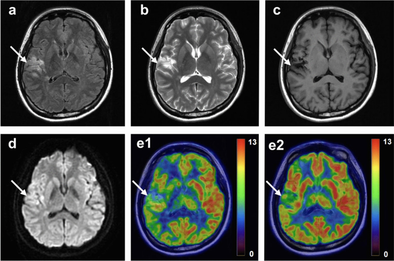 Comparison of the Correlation Between Cerebral [<sup>18</sup>F]FDG Metabolism as Assessed by Two Asymmetry Indices and Clinical Neurological Score in Patients with Ischemic Cerebrovascular Disease.