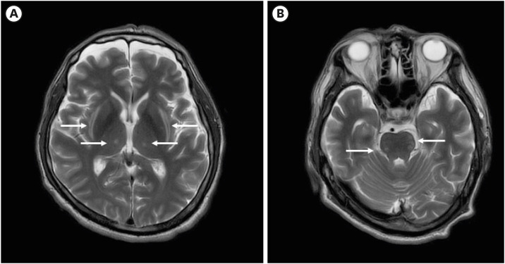 Cytotoxic Lesions of the Corpus Callosum Preceding Osmotic Demyelination Syndrome in Hypernatremia and Hyperosmolar Hyperglycemic State: A Case Report.