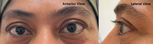 When patients present with bulging eyes: A case series of proptosis.