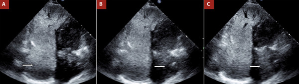 The role of agitated saline contrast echocardiography in the evaluation of pulmonary hypertension.