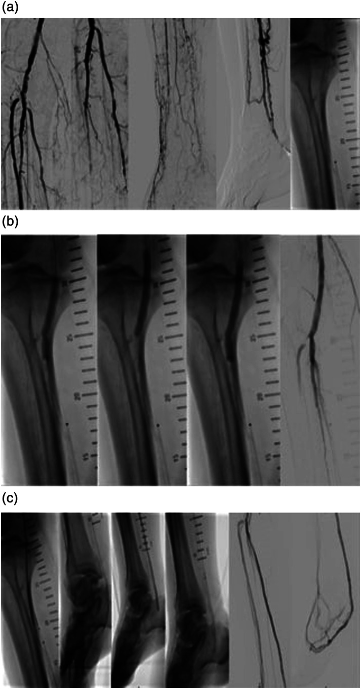 Intravascular lithotripsy-assisted percutaneous deep vein arterialization for no-option chronic limb-threatening patients and heavily calcified tibial occlusive disease.