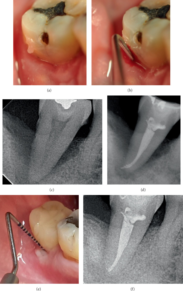 Long-Term Benefits of Periodontal Regeneration in Severely Compromised Teeth: A Retrospective Case Series.