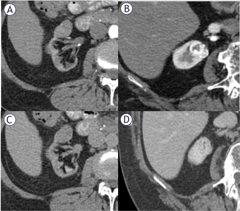 A comparison of effectiveness of the contrast enhanced computed tomography with magnetic resonance imaging in the differential diagnosis of clear cell renal carcinoma.