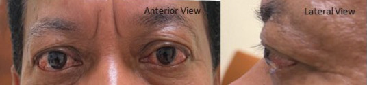 When patients present with bulging eyes: A case series of proptosis.