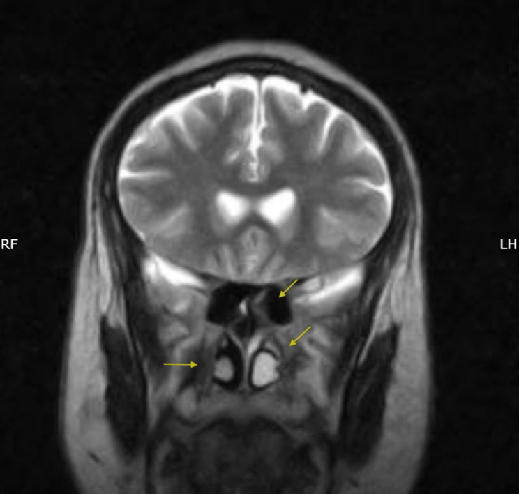 Recurrent Cerebrospinal Fluid Rhinorrhea Secondary to a Seizure-Induced Skull-Base Defect: An Unusual Complication of Epilepsy.