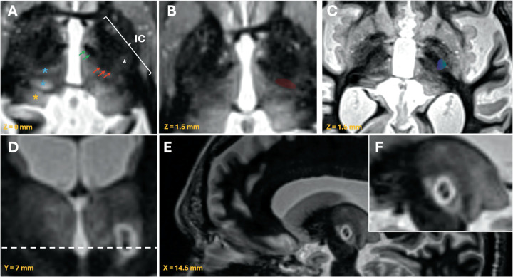 New technique for direct targeting of the ventral intermediate nucleus using magnetic resonance-guided focused ultrasound.