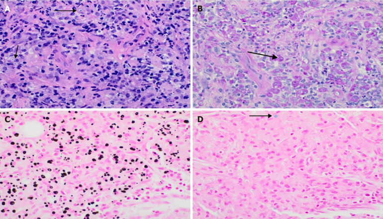 Malakoplakia in kidney transplant recipients: Three case reports.