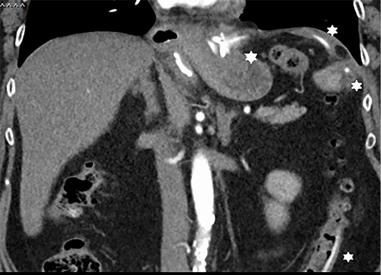 Gastric banding adjustment catheter dislodgement and perforation into the colon: case report.
