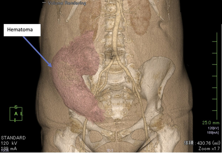 Large Hematoma Following Ultrasound-Guided Rectus Sheath Block.