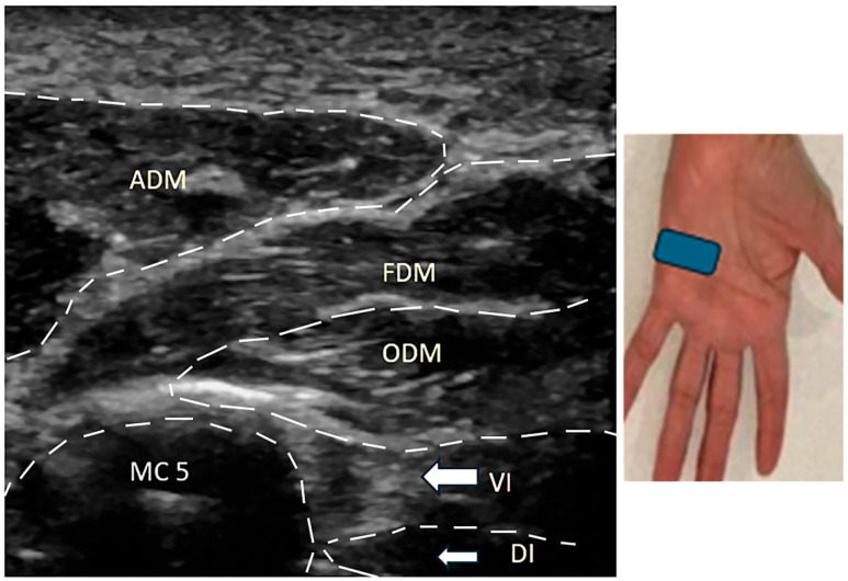A Retrospective Study of 10 Patients Exhibiting the "Pseudo Wartenberg Sign".