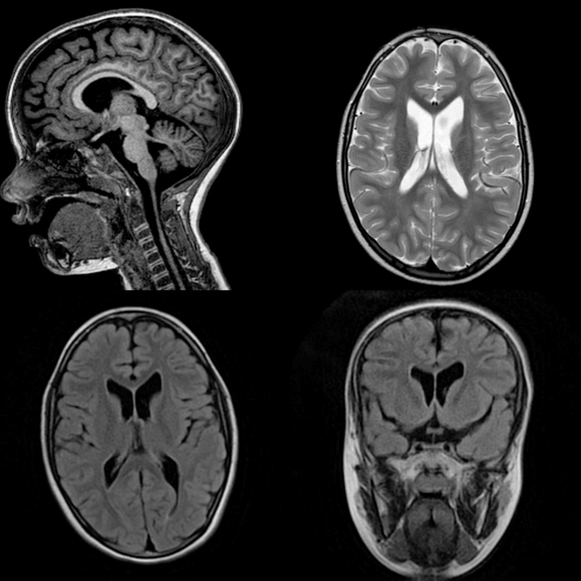 POLR3A rare variants in a patient with intellectual disability, ataxic gait and cortical malformations: a case-report.