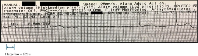 A Case of Intraoperative Reproducible Transient Bradycardia During Total Hip Arthroplasty: Direct Activation of Parasympathetic Vagal Afferents From Bone.